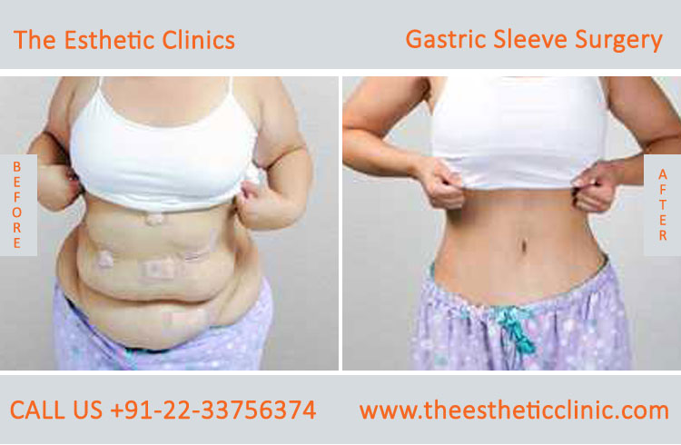 Gastric Sleeve Surgery, bariatric surgery before after photos in mumbai india (6)
